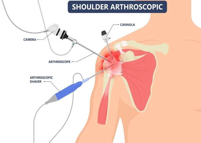 Arthroscopic Labral and SLAP Tear Surgery Orthopedic Shoulder Surgeon