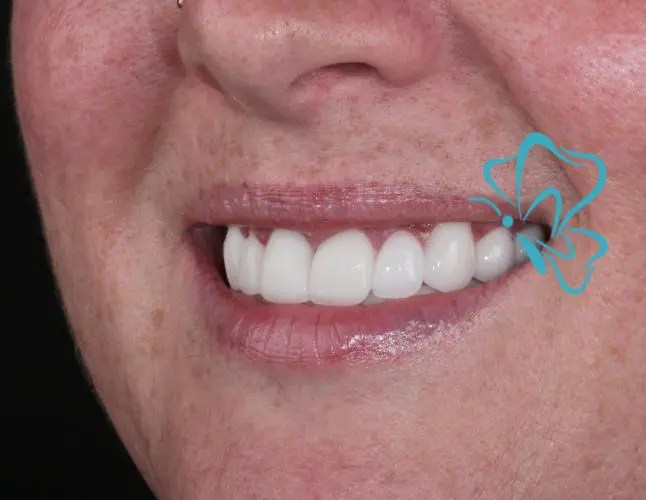 Turkey Teeth as Known as "Getting Your Teeth Done in Turkey" Antalya