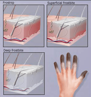 question roughly how long does. 4 How Long Does It Take To Get Frostbite Adventures In Antarctica