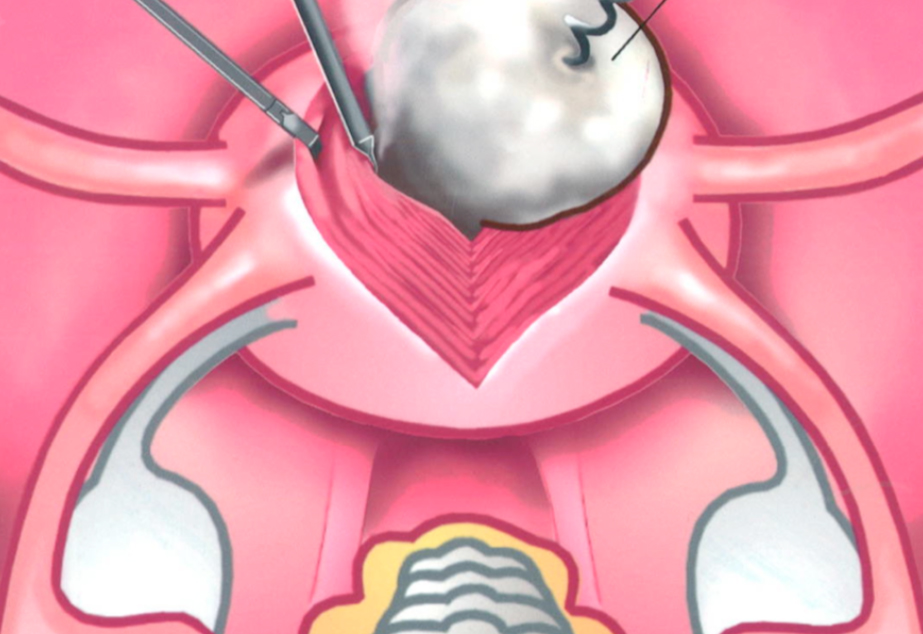 Single Incision Laparoscopy Landmark Cases Anthony Siow