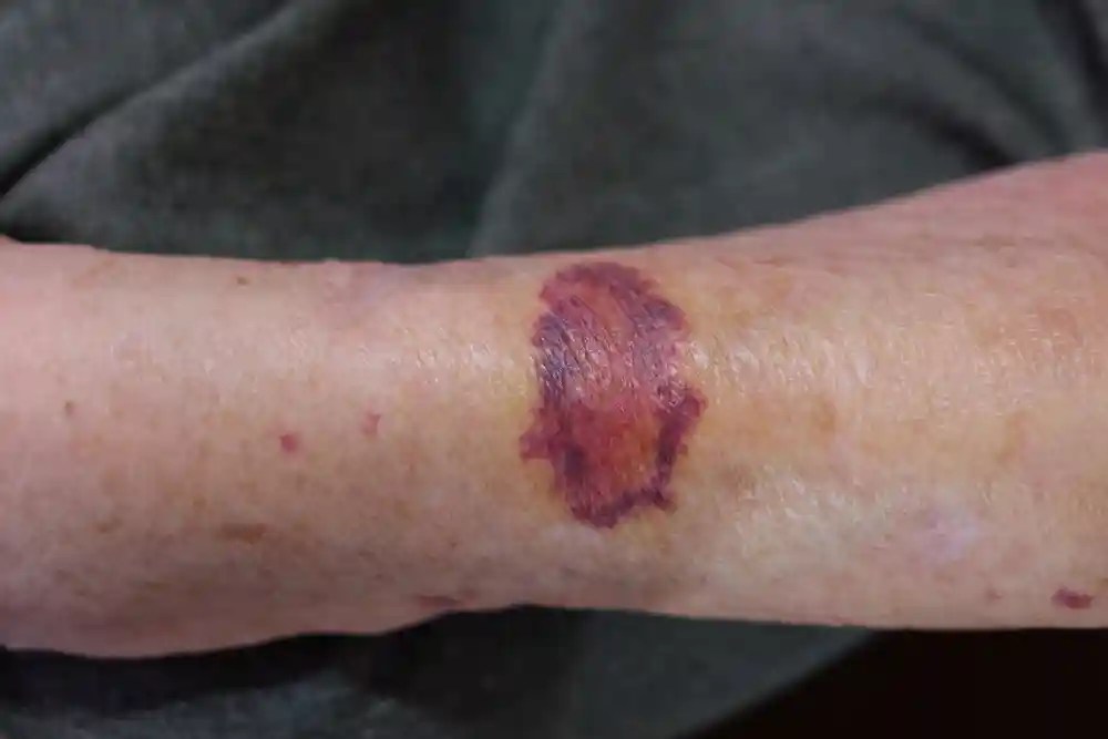 9 Leukemia Rashes, Bruises, and Other Skin Manifestations Page 2 of 9