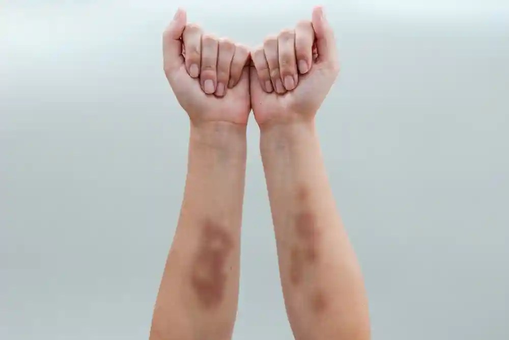 How Does Leukemia Bruising Differ from a Normal Bruise? Page 2 of 8