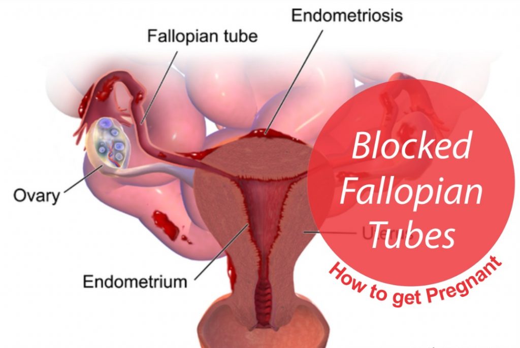 7 Steps to get pregnant with blocked fallopian tubes