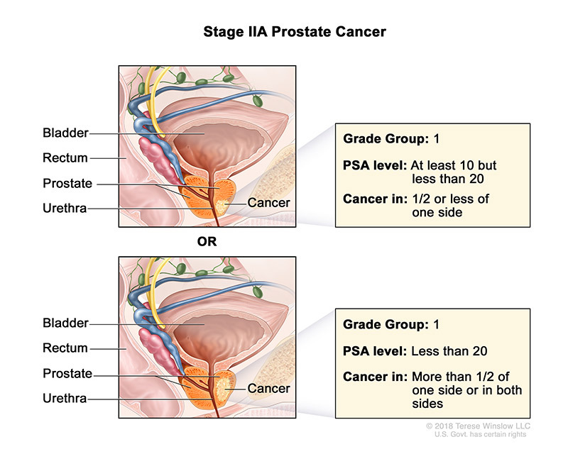 Prostate Cancer Staging Affiliated Oncologists
