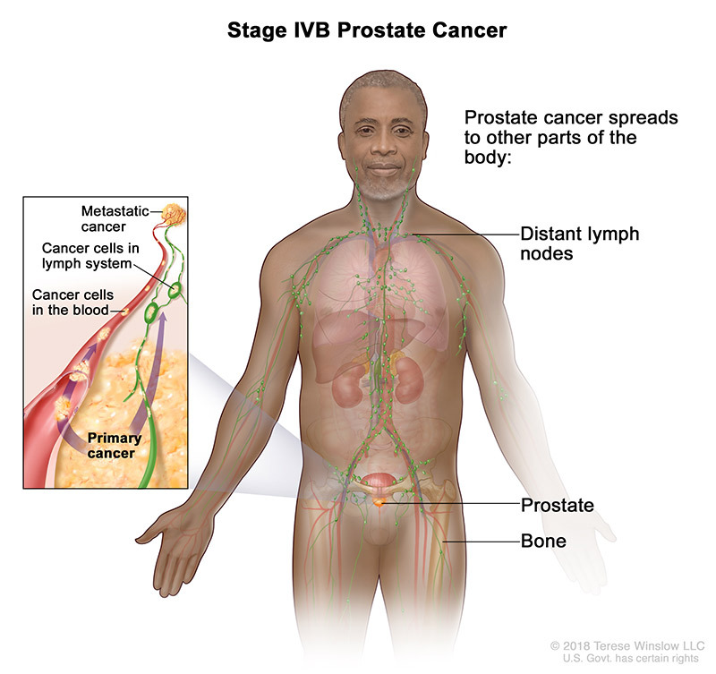 Prostate Cancer Staging Affiliated Oncologists