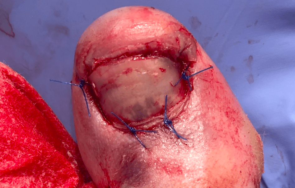 Approach to Nail Trauma AOMC FOAMed