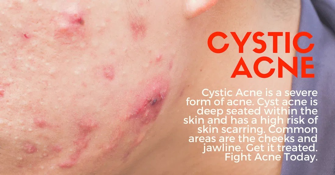 What Causes Cystic Acne Effective solutions APAX Medical(02)