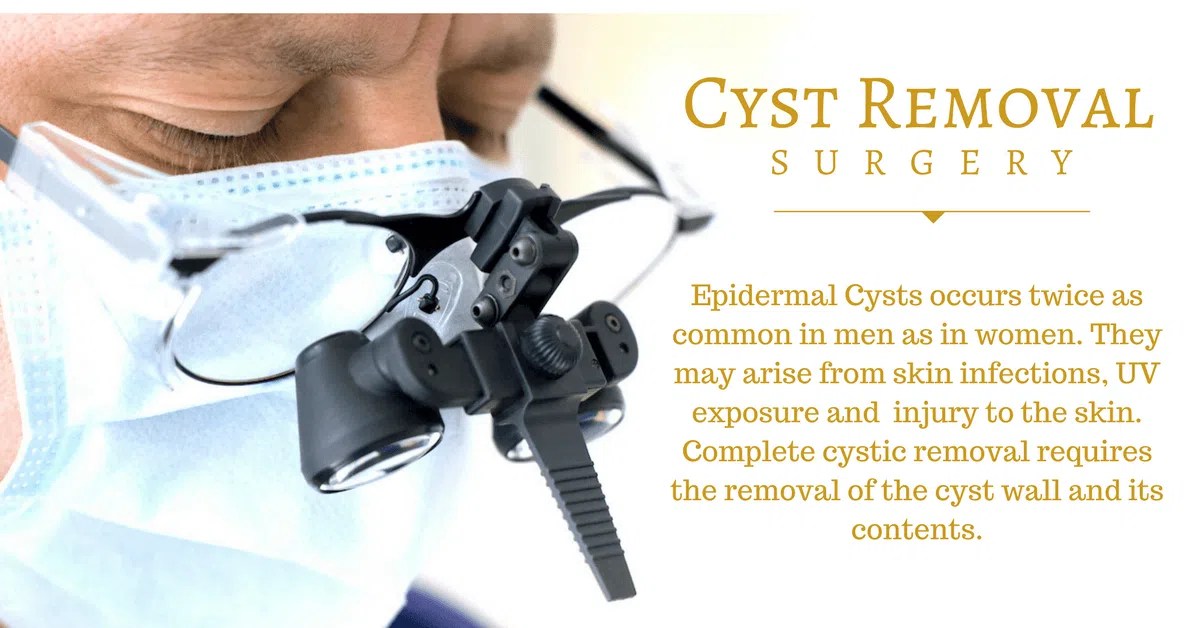 Effective Sebaceous Cyst Removal Singapore Minimal Downtime
