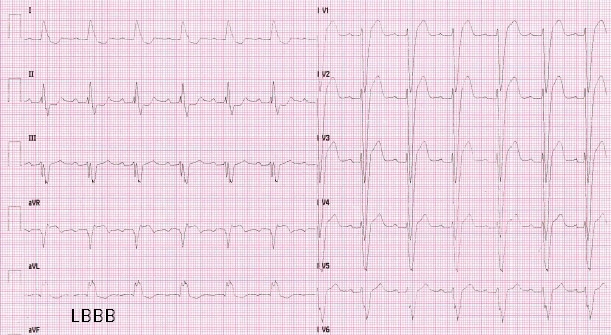 Bradyarrhythmias A.P.D.I.C.