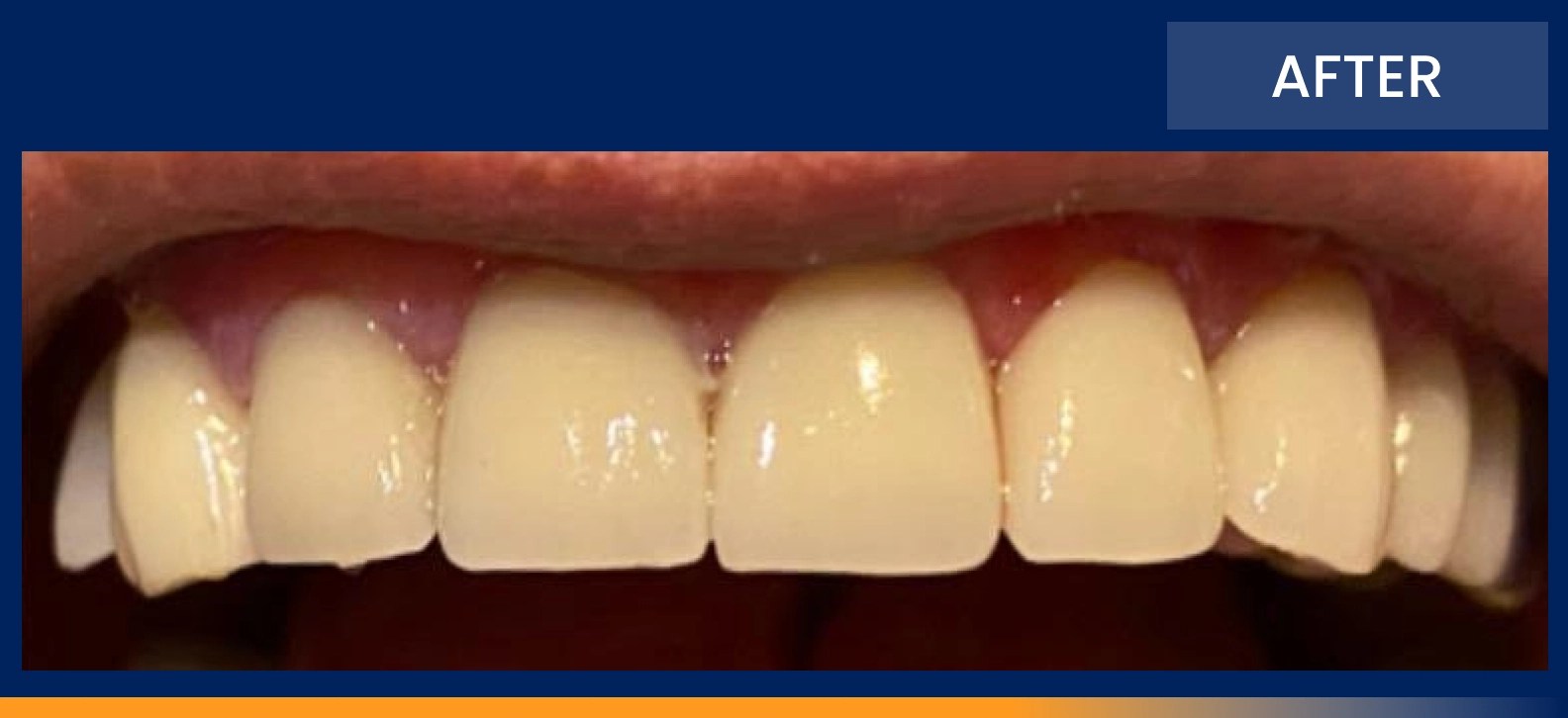 Before & Afters Dentist in Fort Pierce, FL 34982