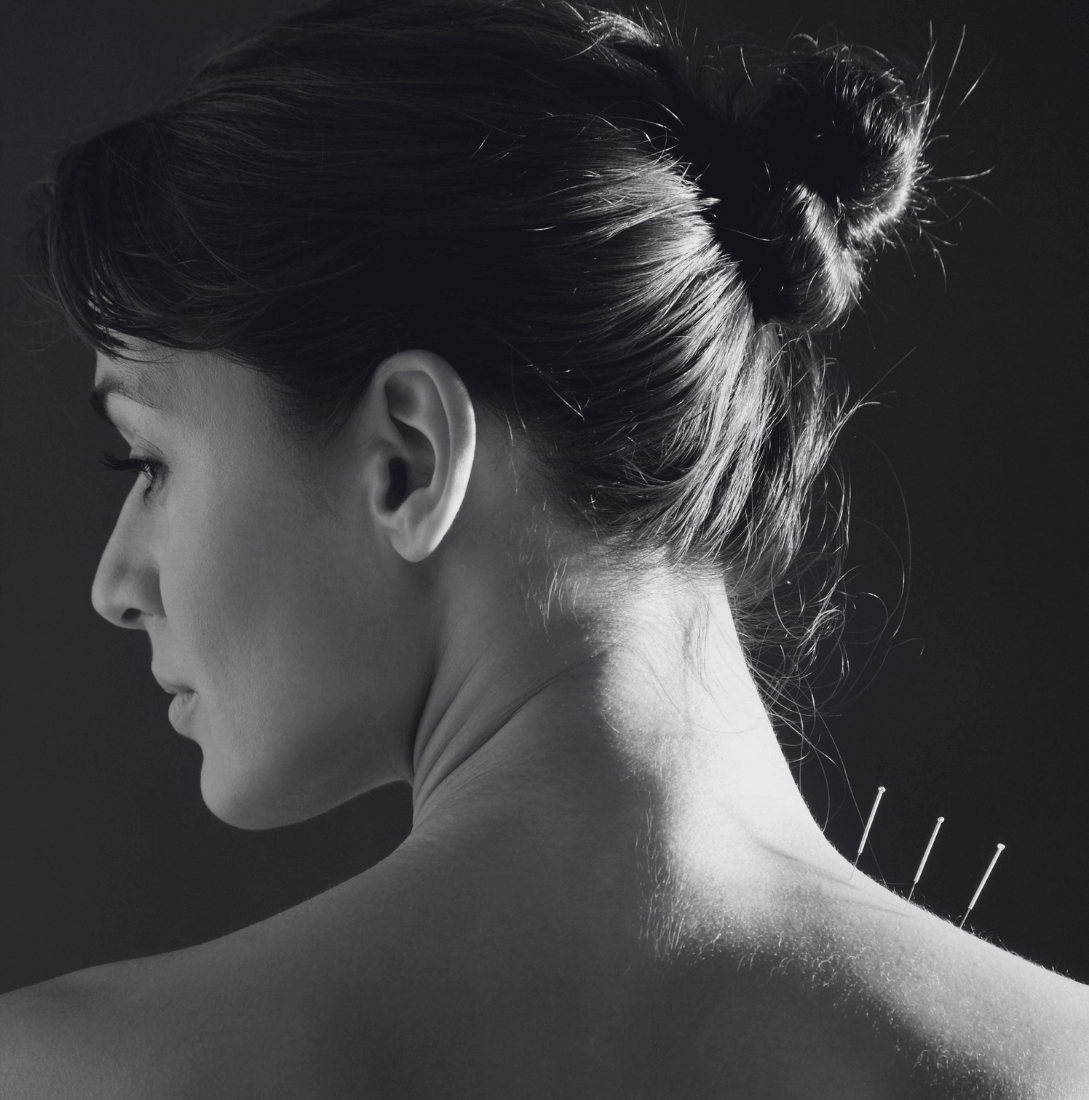 Unlocking Hope The Power of Acupuncture When IVF Fails Aphrodite Blog