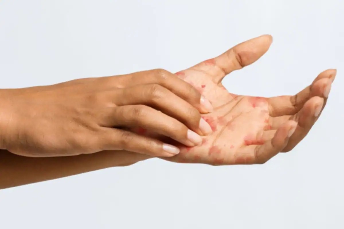 A Complete Guide to the Types of Dermatitis