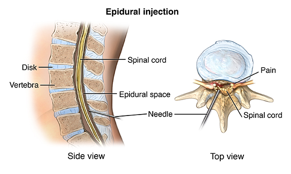 The most common cable in schools is unshielded twisted pair, which is most often used with star topologies. Back And Neck Pain Cedars Sinai