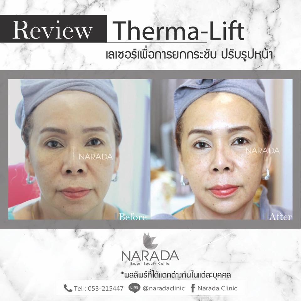 Albums 98+ Pictures Therma Lift Before And After Pictures Latest