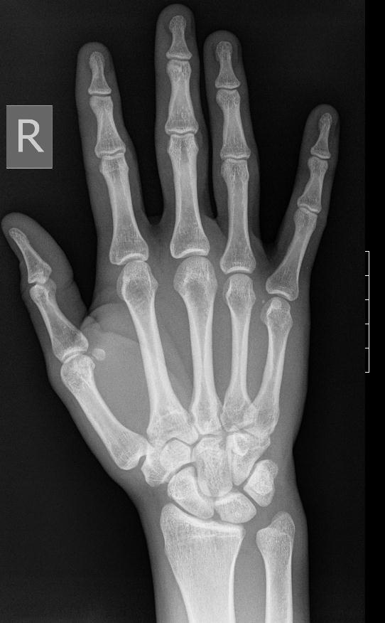 Xray of the Right Hand Academy of American Poets