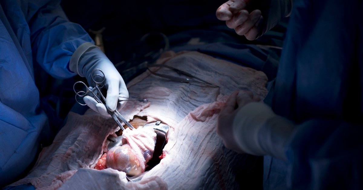The First Successful Kidney Transplant Time The First Successful Kidney Transplant Time