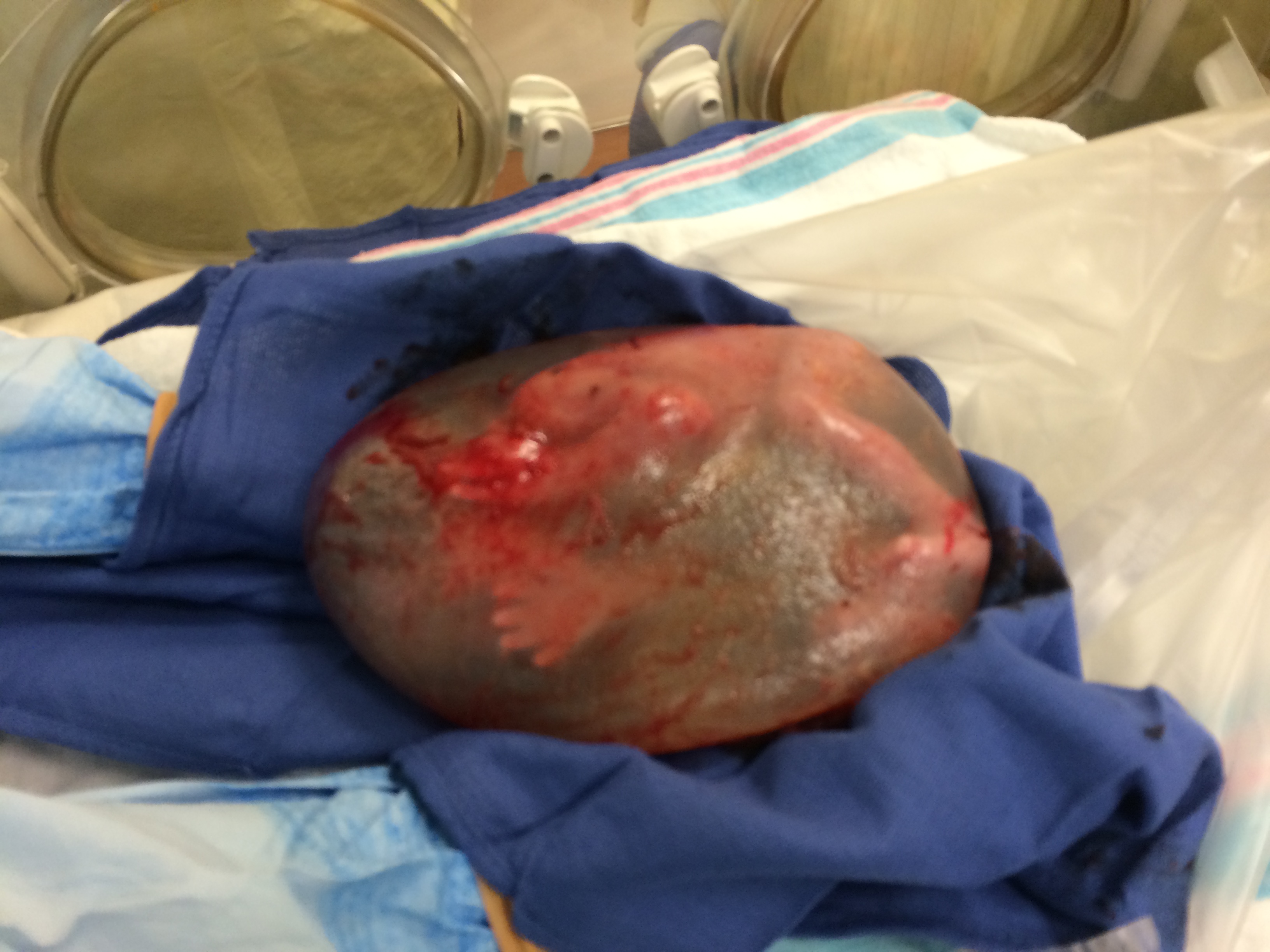 Baby Born Encased in Amniotic Sac Time