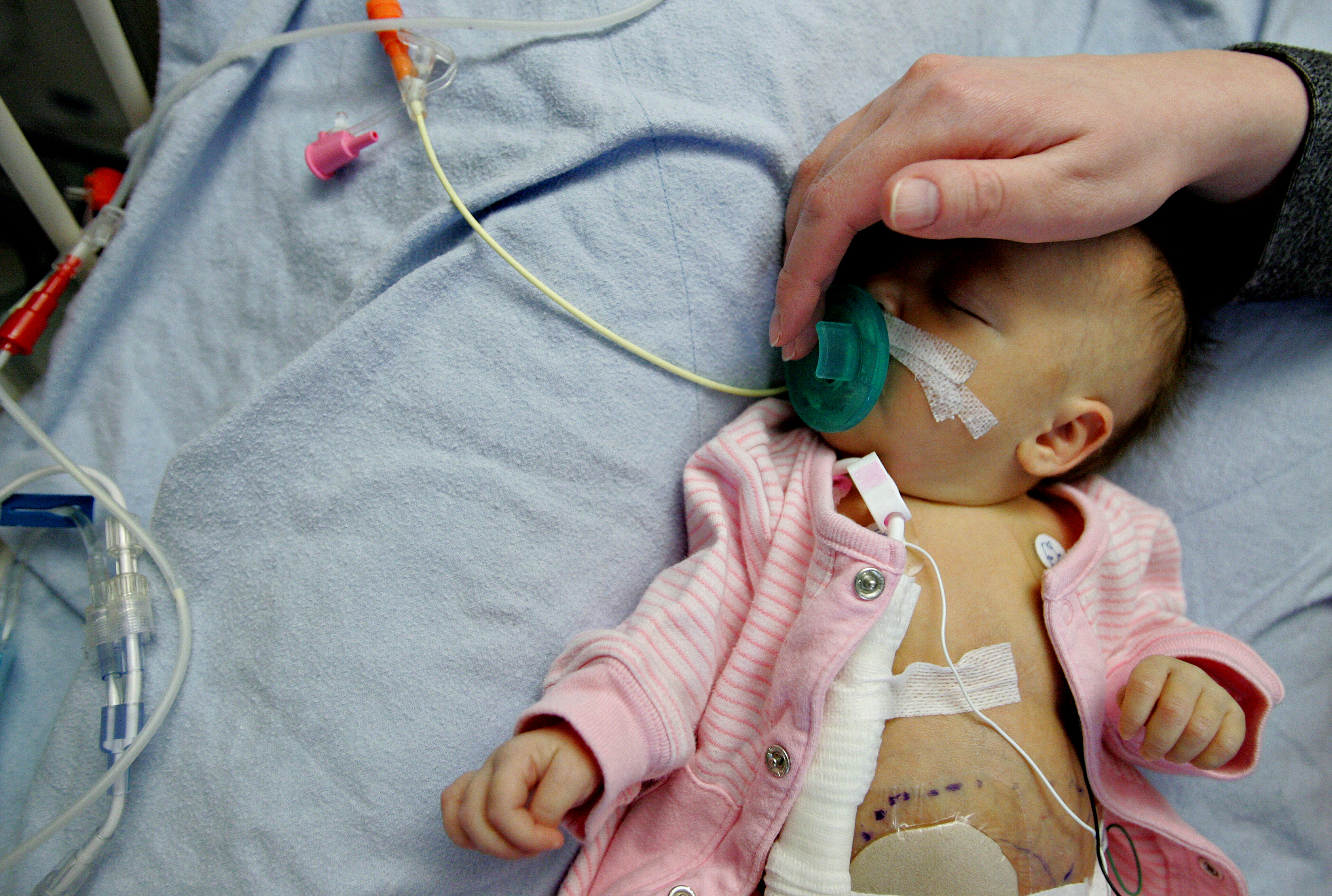 More Babies Are Being Born With Organs Outside Their Body Time