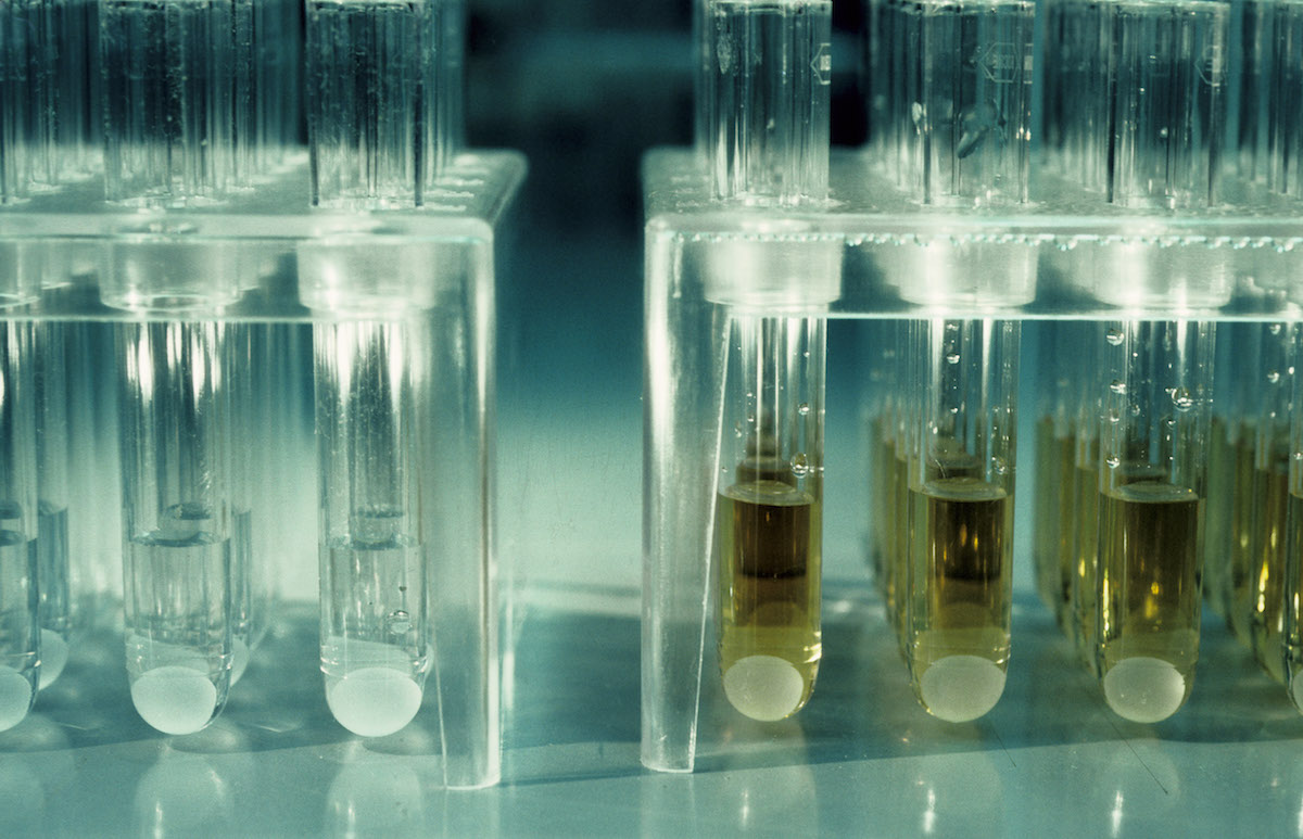 National HIV Testing Day How the Test Was Invented Time