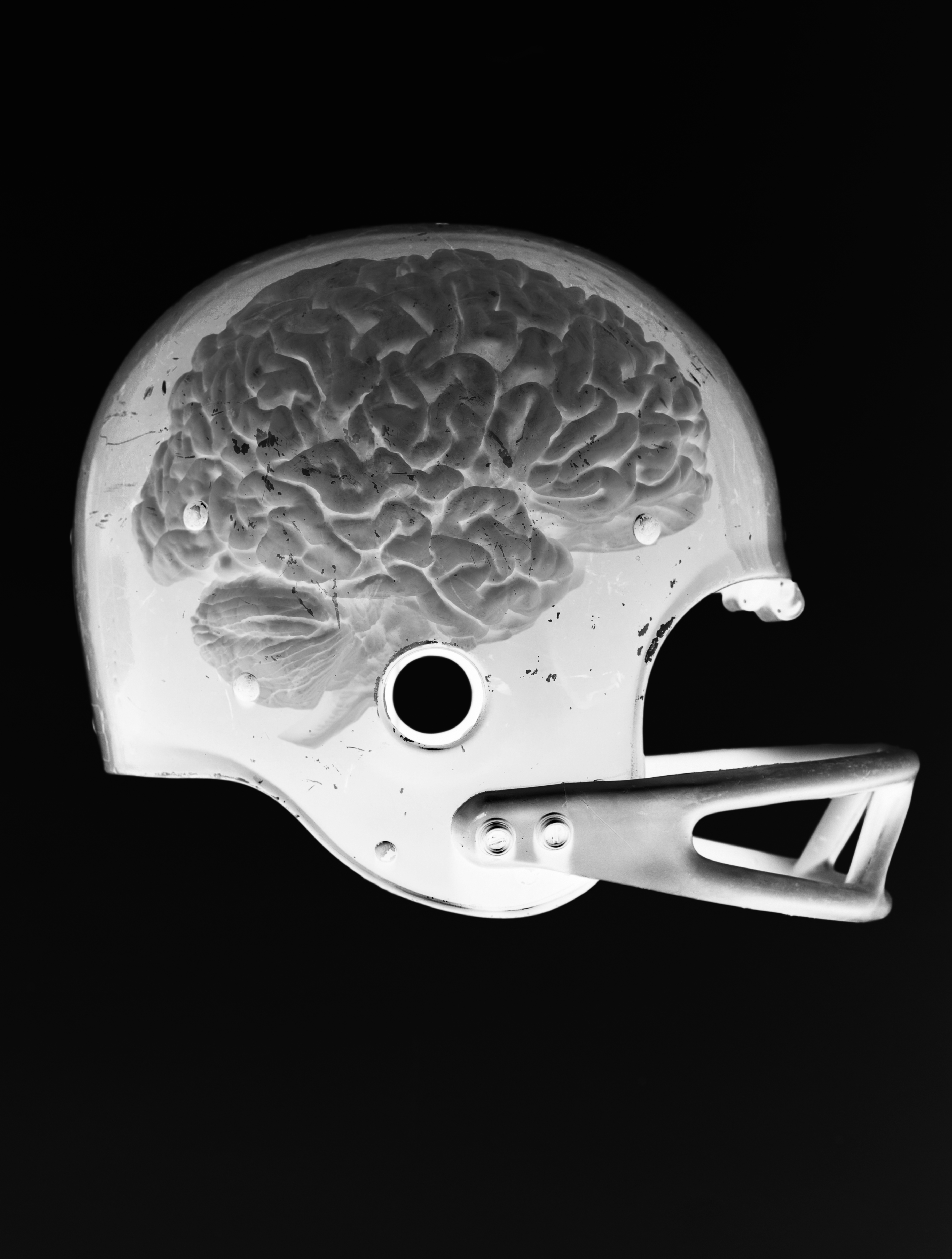 Concussions in Kids Every Impact Causes Brain Changes TIME