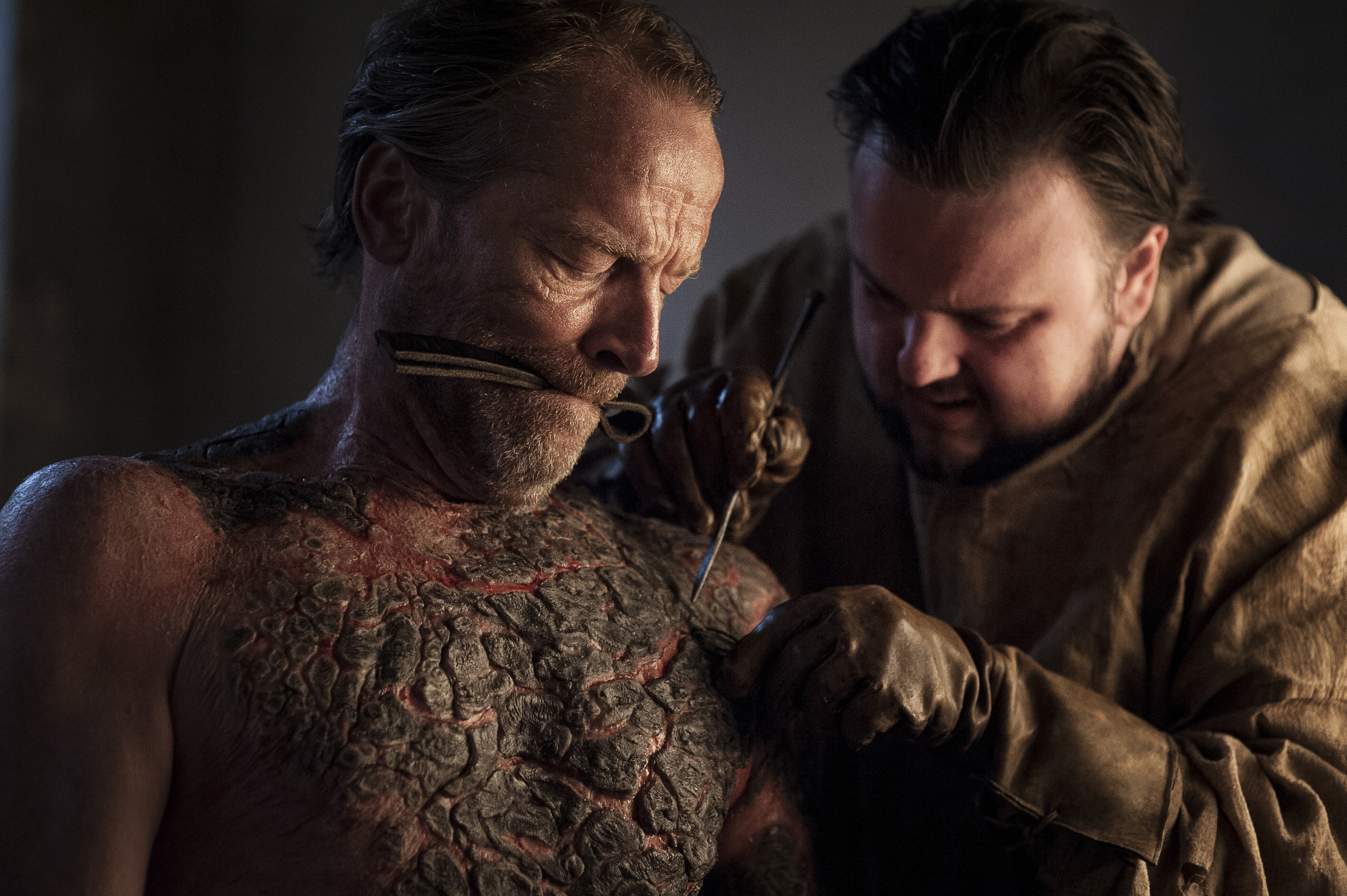 Game of Thrones, Greyscale and the Real History of Leprosy Time
