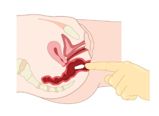 6.13. Steps And Procedures For The Different Routes Of Medication Administration(Insertion). | Aplmed Academy