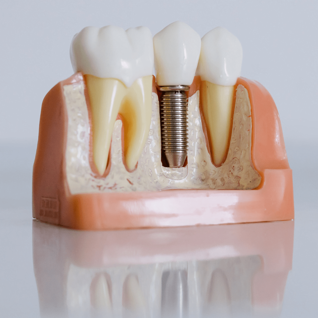 Best Dental Implants in Hyderabad Apollo Dental KPHB