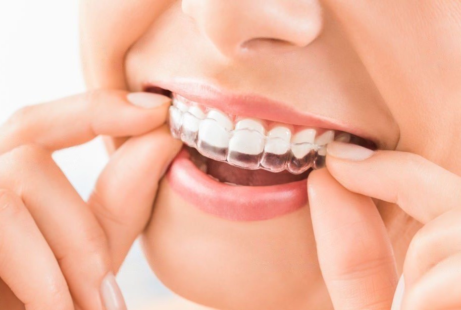 Dental Braces in Abu Dhabi Orthodontist in Abu Dhabi