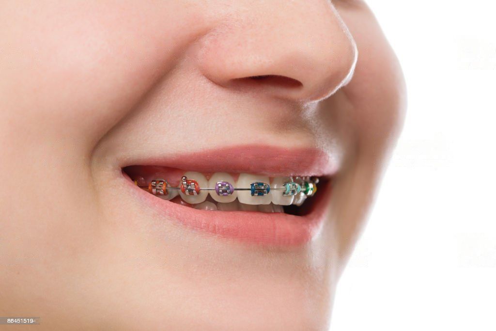 Dental Braces in Abu Dhabi Orthodontist in Abu Dhabi