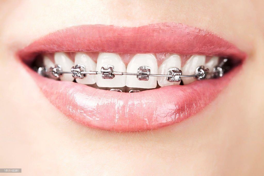 Dental Braces in Abu Dhabi Orthodontist in Abu Dhabi