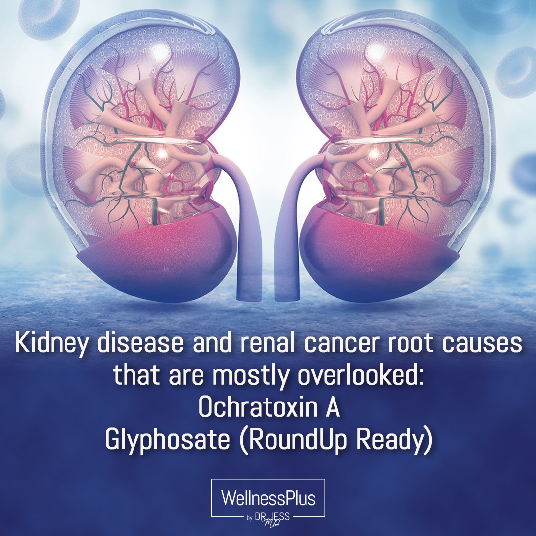 Kidney disease and renal cancer root causes that are mostly overlooked are Ochratoxin A and