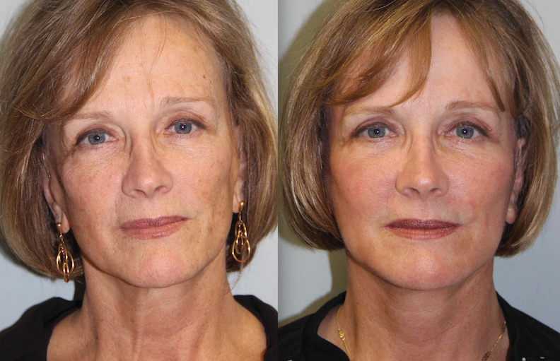 Face Lift & Neck Lift Appearance Center of Newport Beach, Orange County