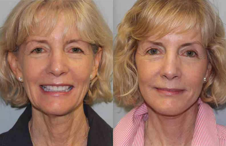 Face Lift & Neck Lift Appearance Center of Newport Beach, Orange County