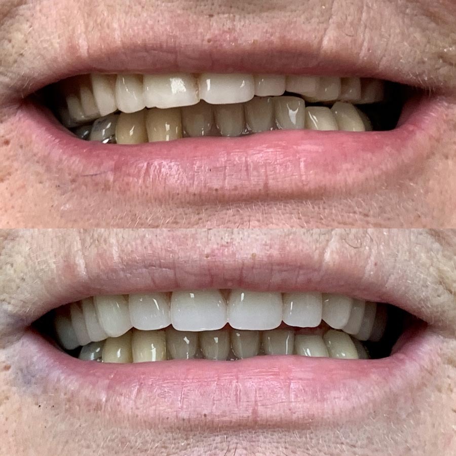 Complete upper denture