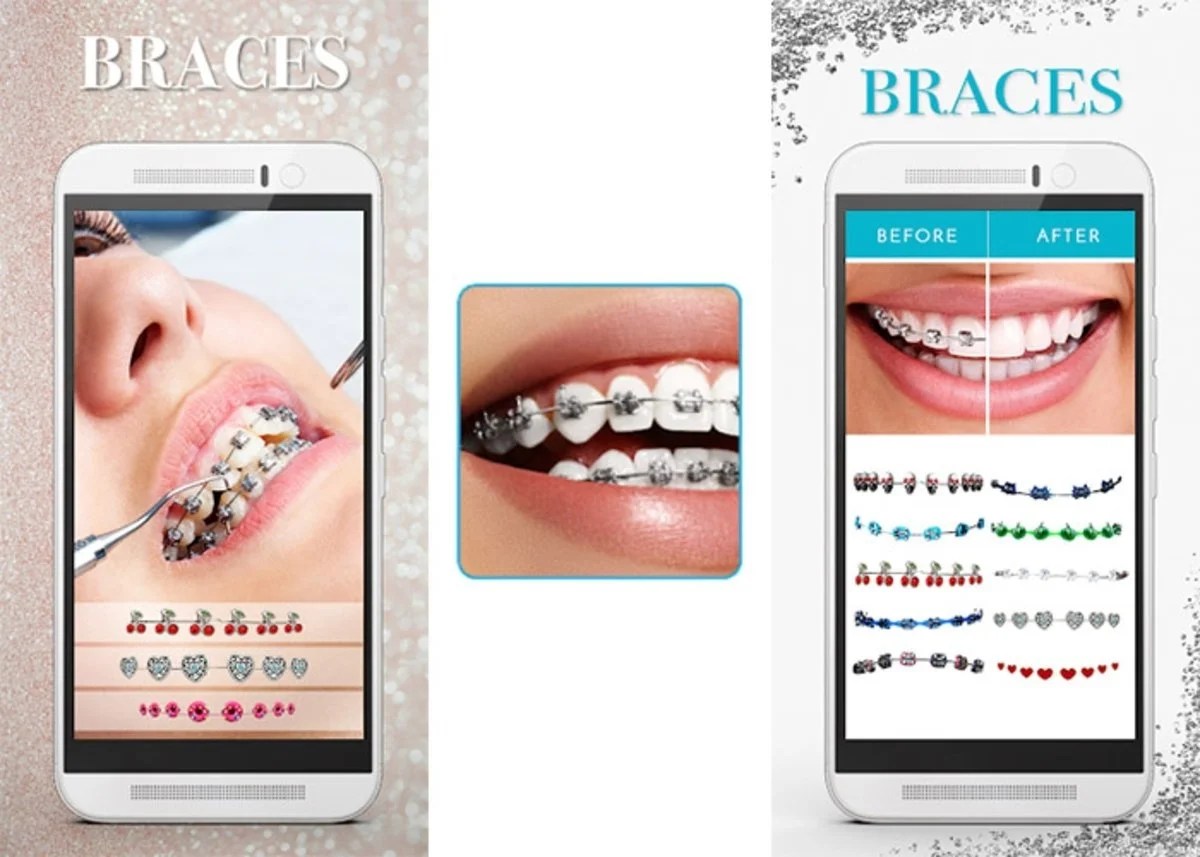 ¿Poner brackets? Apps para saber como me vería con brackets