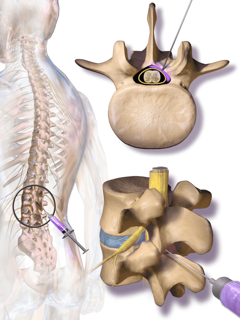 Lumbar Spine Epidural Injection Associated Pain Specialist