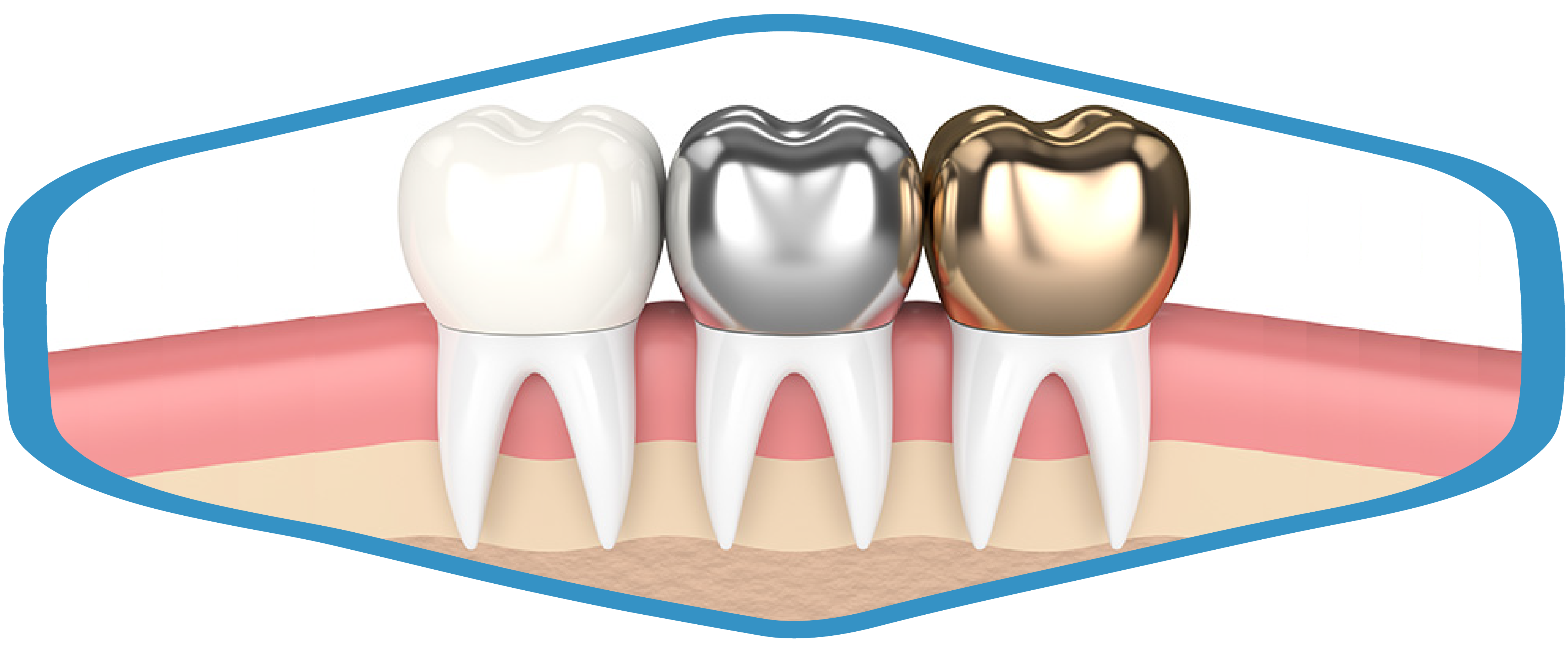 Full Metal Crowns Dental Service Aqudent Dental Lab Inc