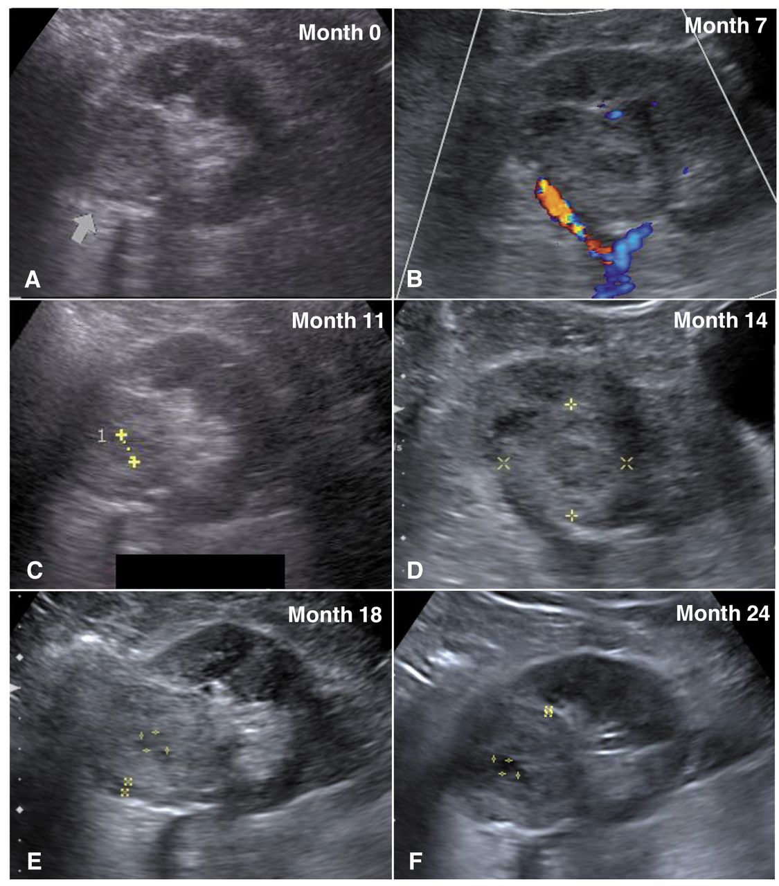 Bilateral Asynchronous Renal Cell Carcinoma With Lung Metastases A