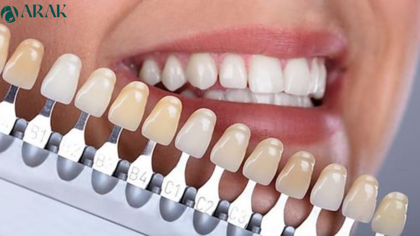 Teeth Color Chart What color are your teeth? Arak Clinic
