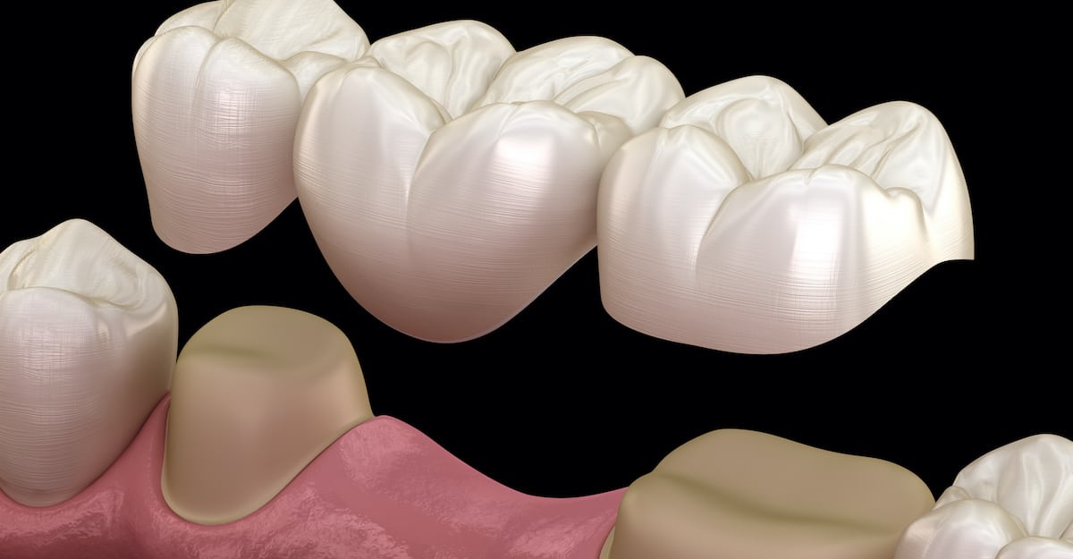 How Long Do Dental Bridges Last? Caldwell, Bills, Petrilli & West
