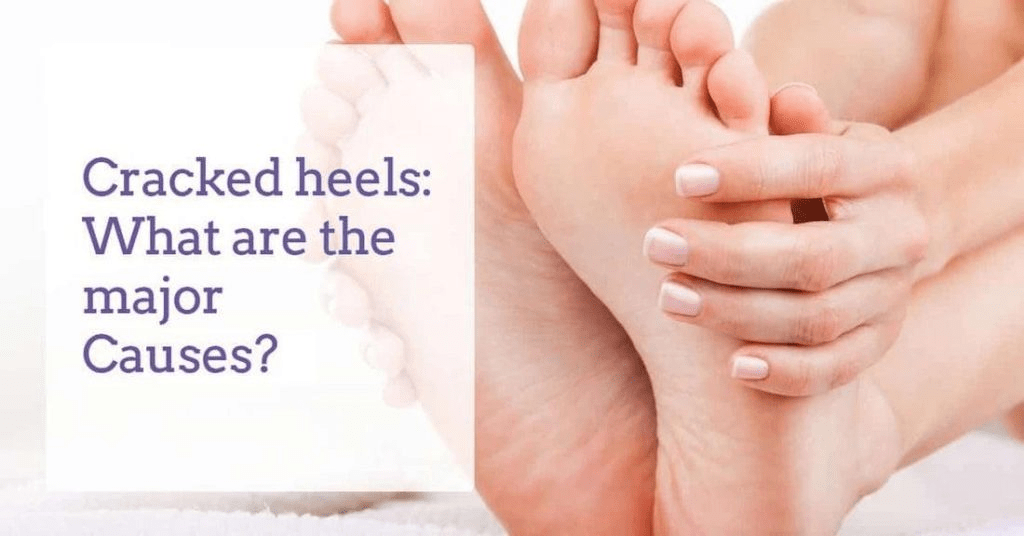 Heel Fissures Causes, Treatment, and Prevention