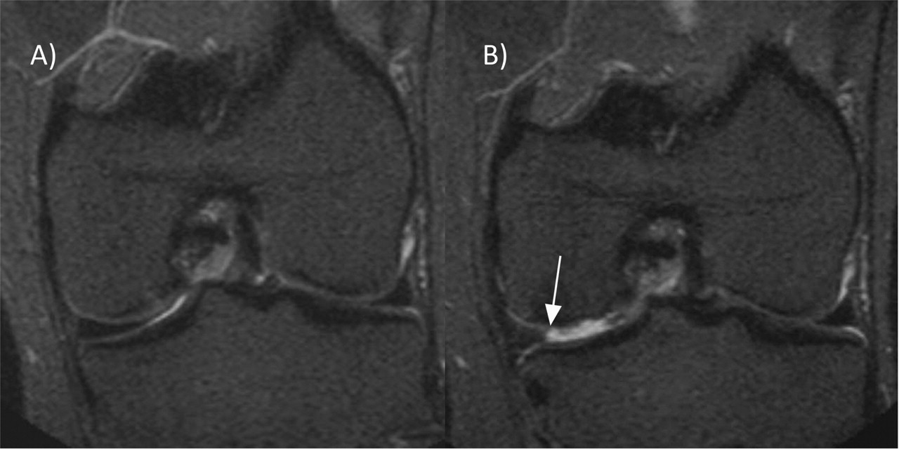 maceration of the medial meniscus HughBecker's blog