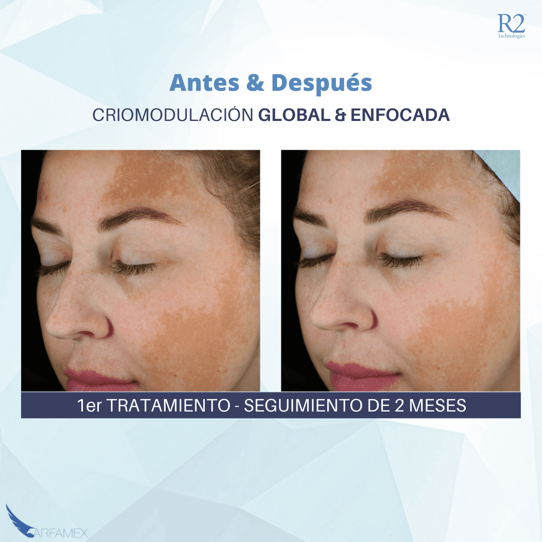 GLACIAL RX en México Arfamex equipos para dermatología y oftalmología