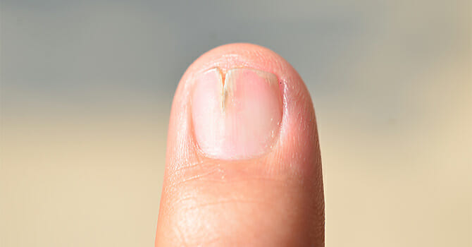 Protecting Nails from Abnormalities!