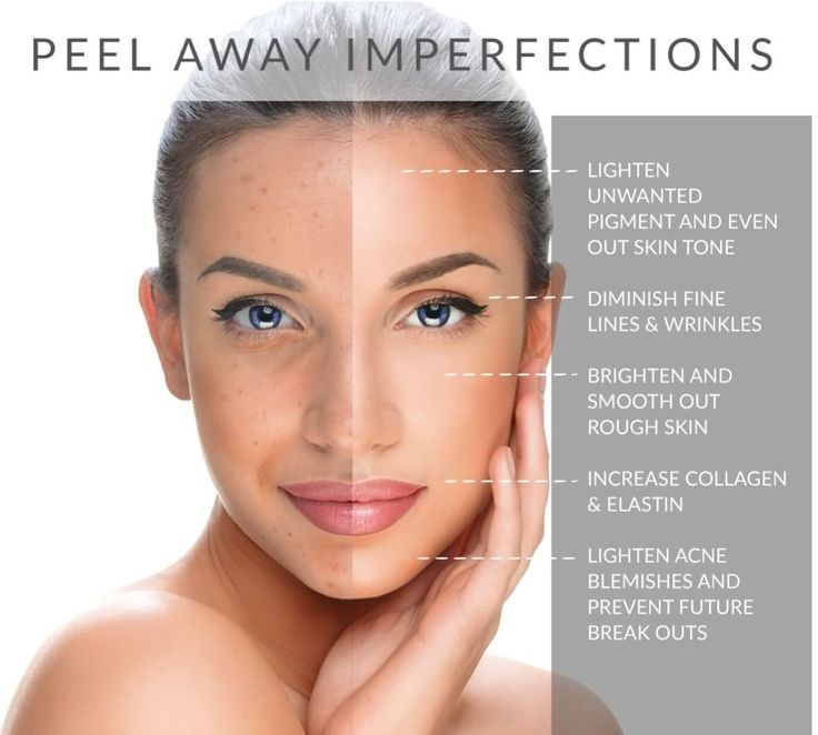 Chemical Peels Argyle Med Spa & Wellness Center