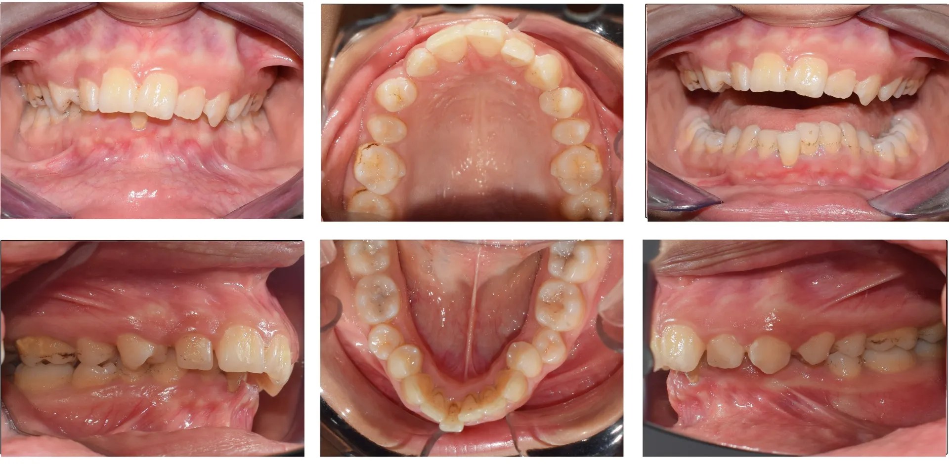 Overjet Braces Aligner Treatment in Vadodara