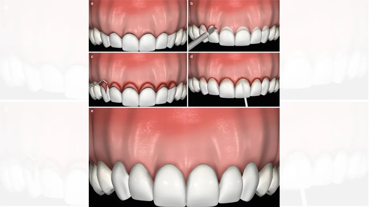 Crown Lengthening Gum Recontouring Aries OroFacial Dental