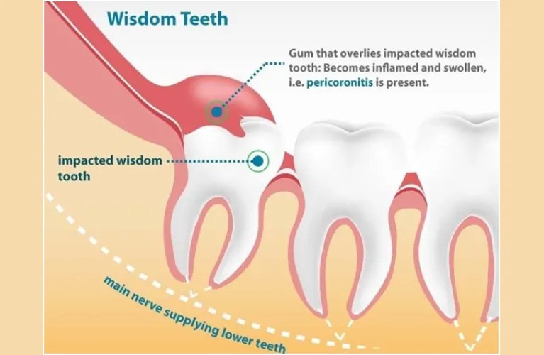 Pericoronitis Wisdom Tooth Removal Aries OroFacial Dental