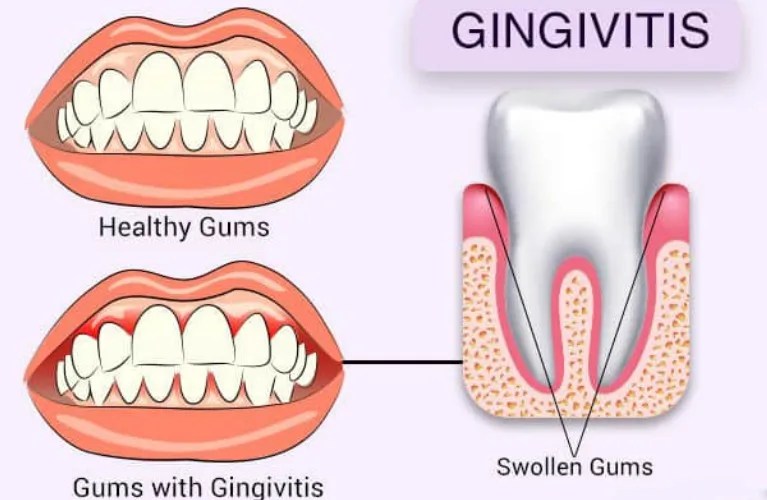 Gum Swelling and Bleeding Gums Gingivitis Treatment Aries Oro