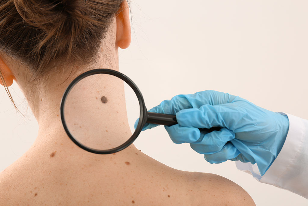 Mole Removal Singapore Arium Clinic Medical Aesthetics
